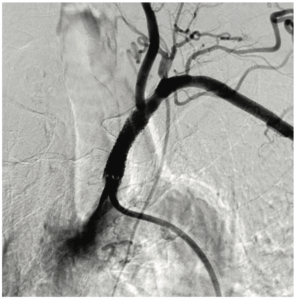 Shah Subclavian Steal Syndrome Figure 3