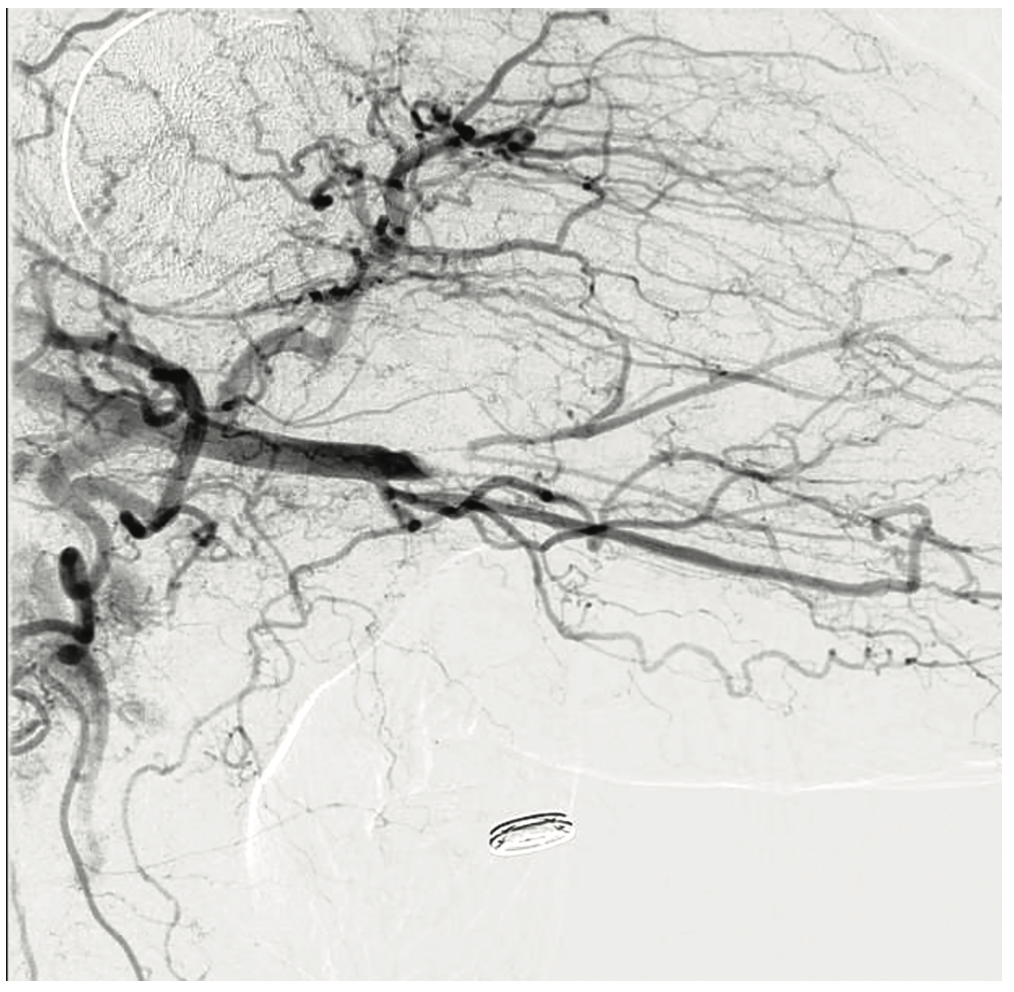 Shah Subclavian Steal Syndrome Figure 4