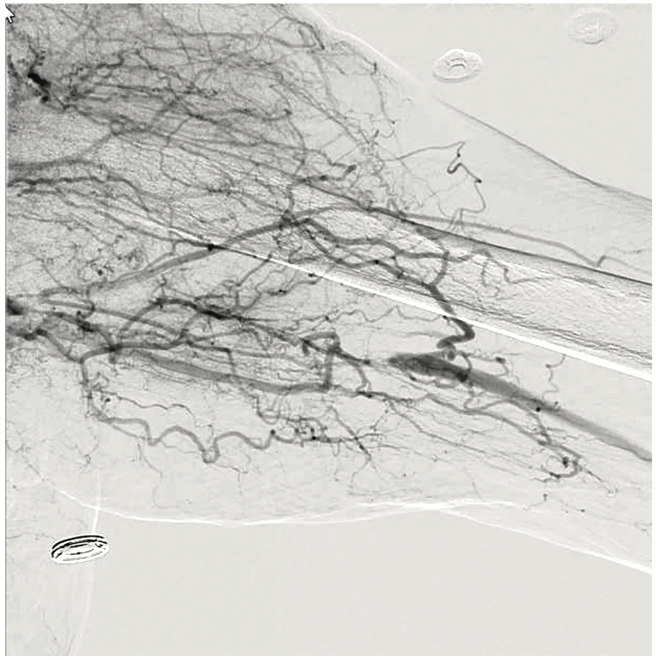 Shah Subclavian Steal Syndrome Figure 5