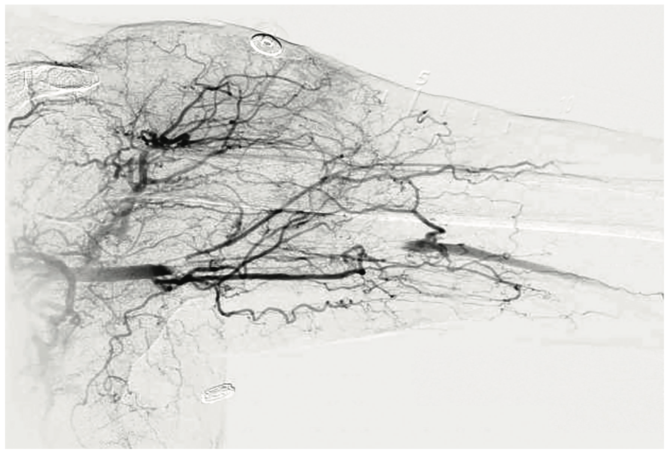 Shah Subclavian Steal Syndrome Figure 6