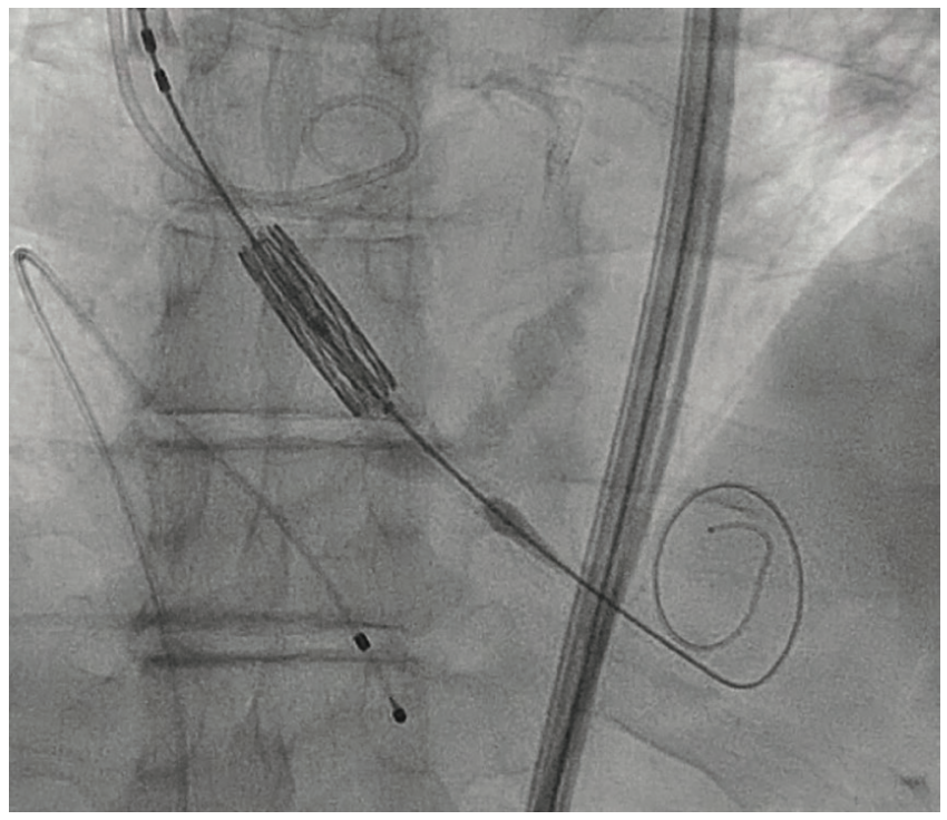 Shah TAVR Figure 1