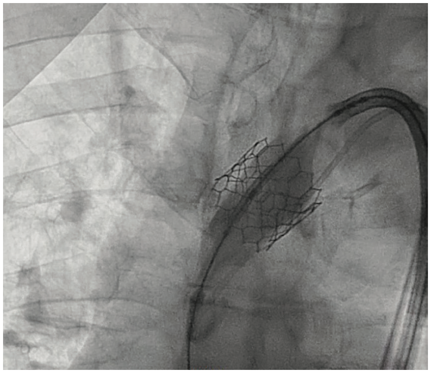 Shah TAVR Figure 4