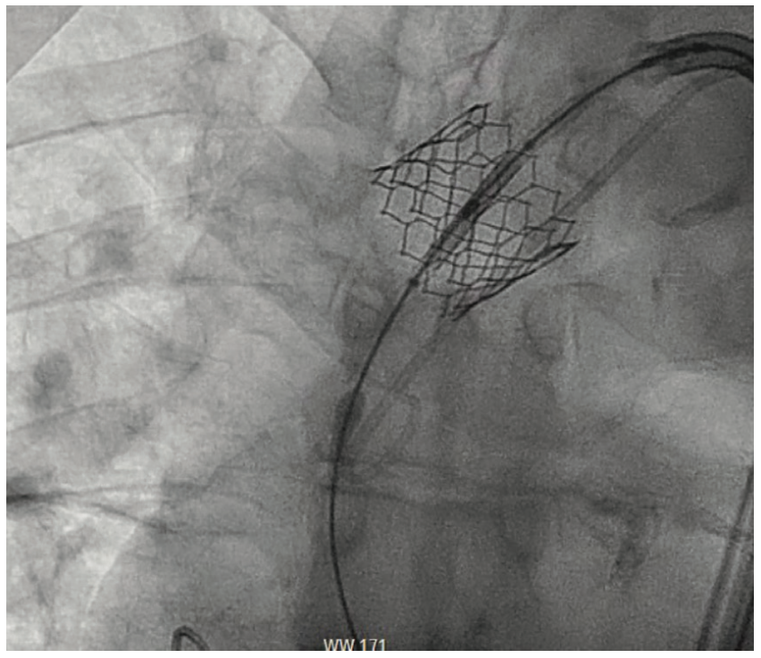 Shah TAVR Figure 5