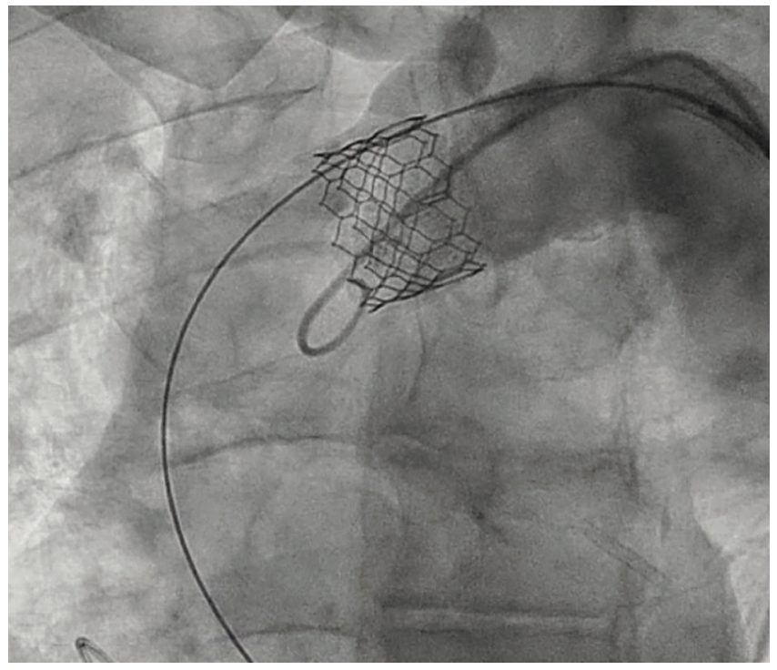 Shah TAVR Figure 6