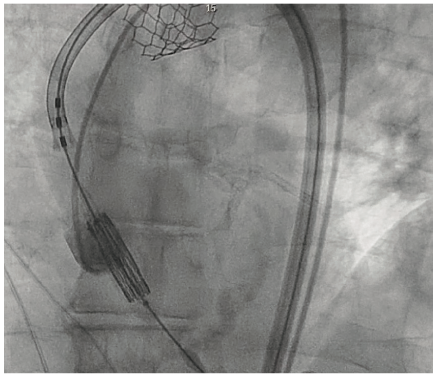 Shah TAVR Figure 7