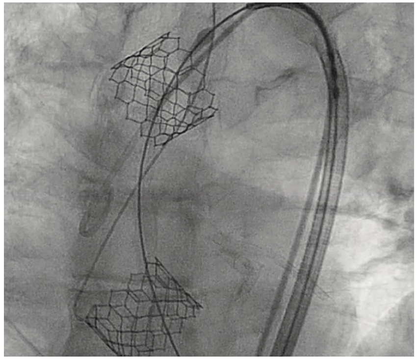 Shah TAVR Figure 8