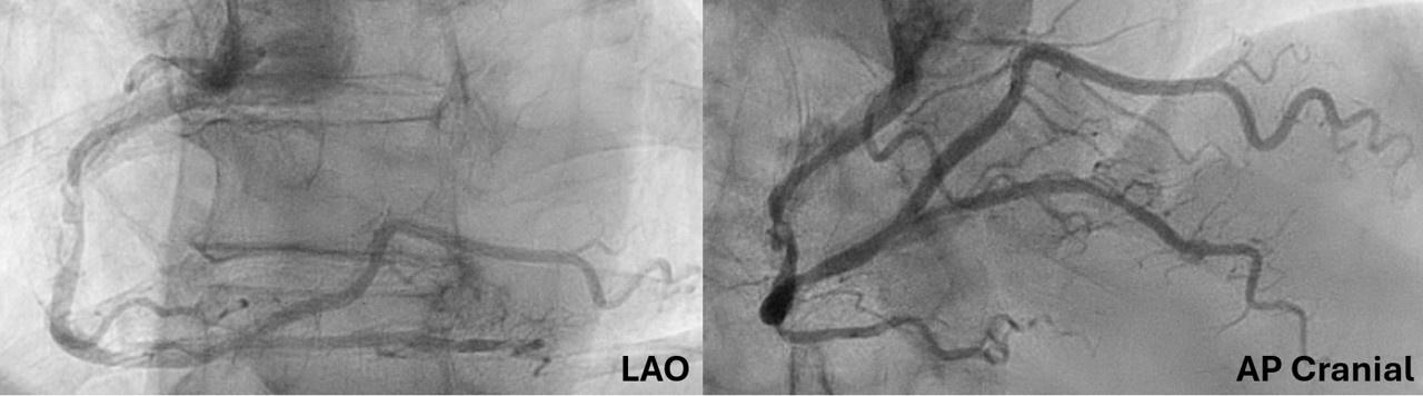 Figure 1. Baseline right coronary artery angiogram
