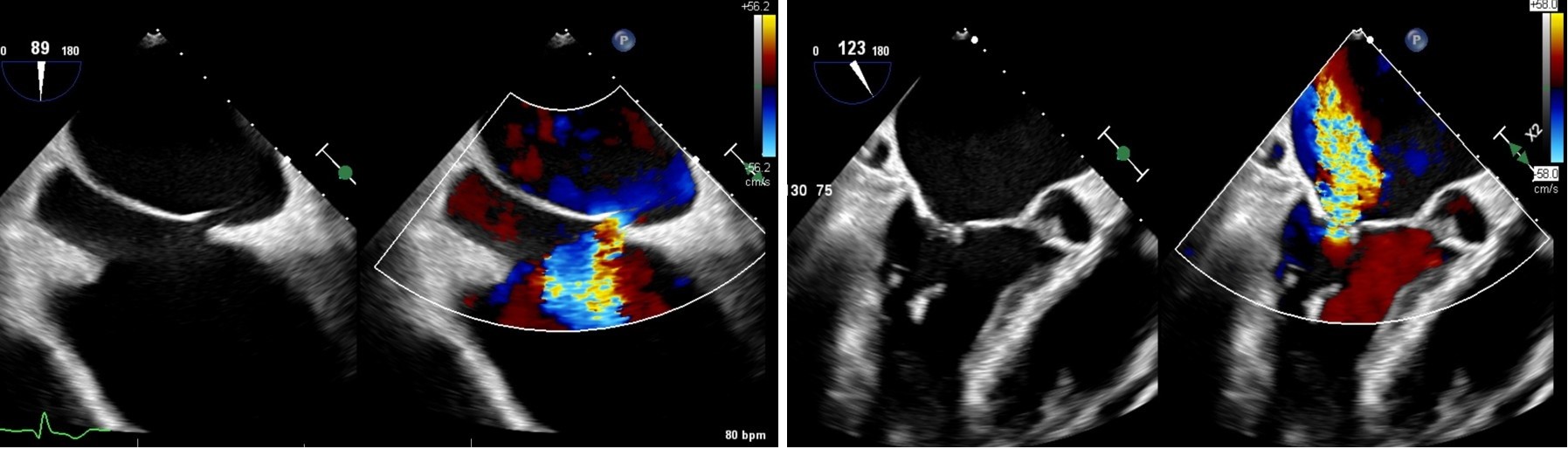 Figure 1. Baseline transesophageal echocardiography showed (A) a secundum atrial septal defect and (B) severe mitral regurgitation