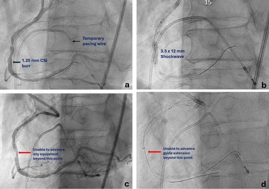 Figure 2. Orbital atherectomy