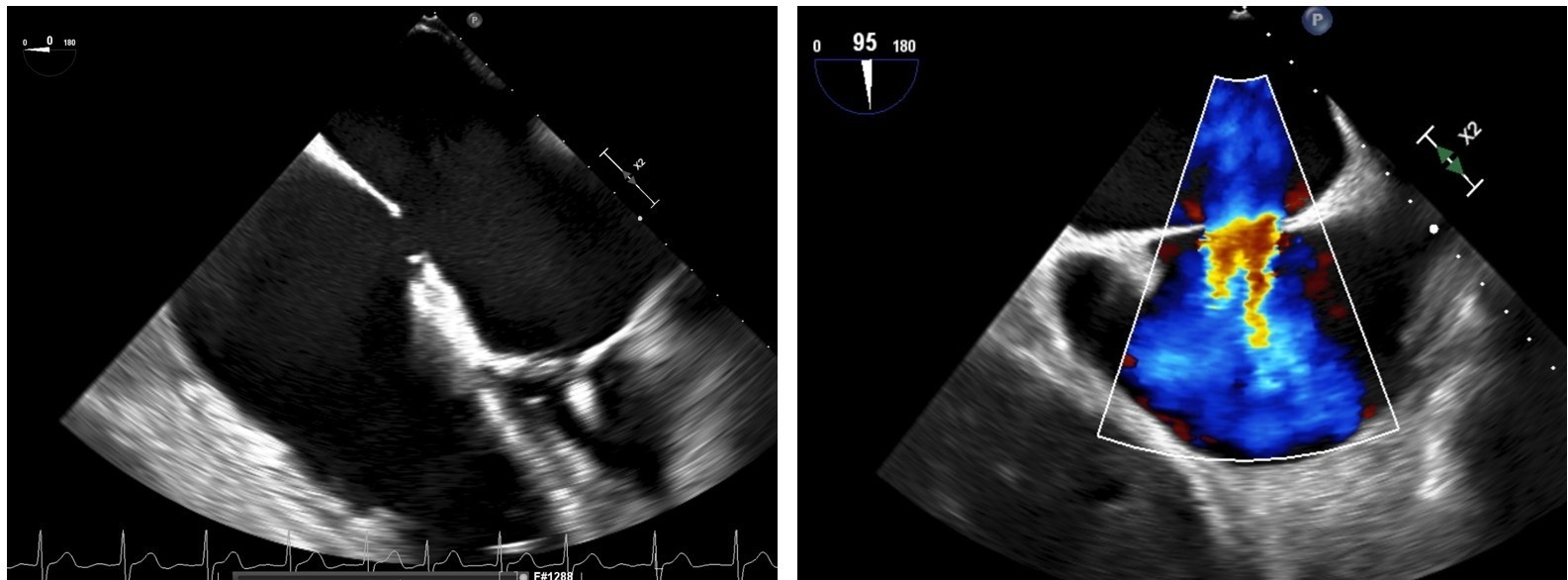 Figure 2. Enlarged atrial septal defect after transseptal puncture for the MitraClip (Abbott).