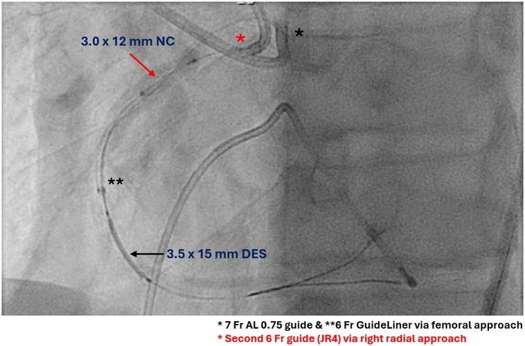 Figure 3. Modified “tunnel-in-landslide” technique (TILT) 
