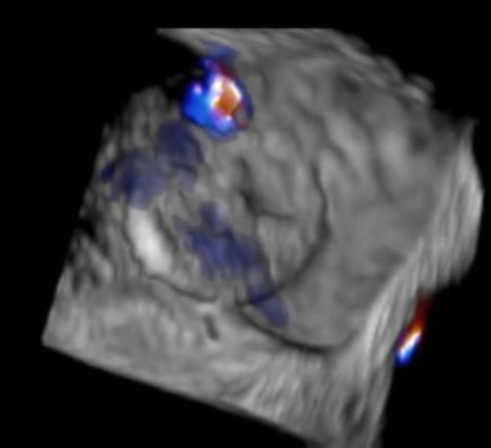 Figure 3. Residual defect inferior/posterior to the Amplatzer Cribriform Occluder (Abbott).