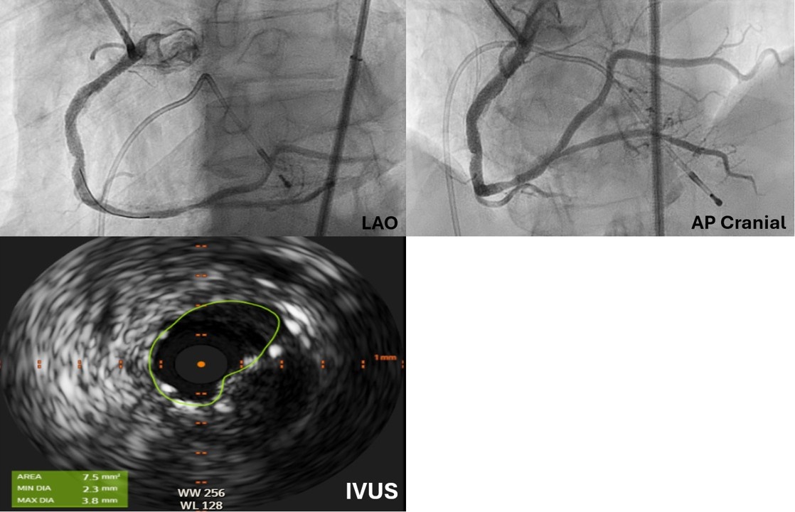 Figure 4. Final angiogram and intravascular ultrasound