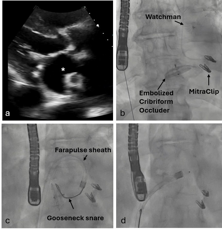 Figure 4. retrieval of the embolized Amplatzer Cribriform Occluder
