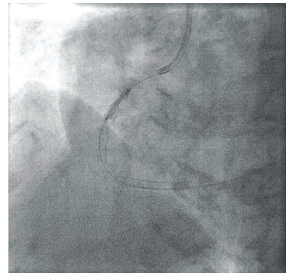 Shahab Intravascular Lithotripsy Figure 3