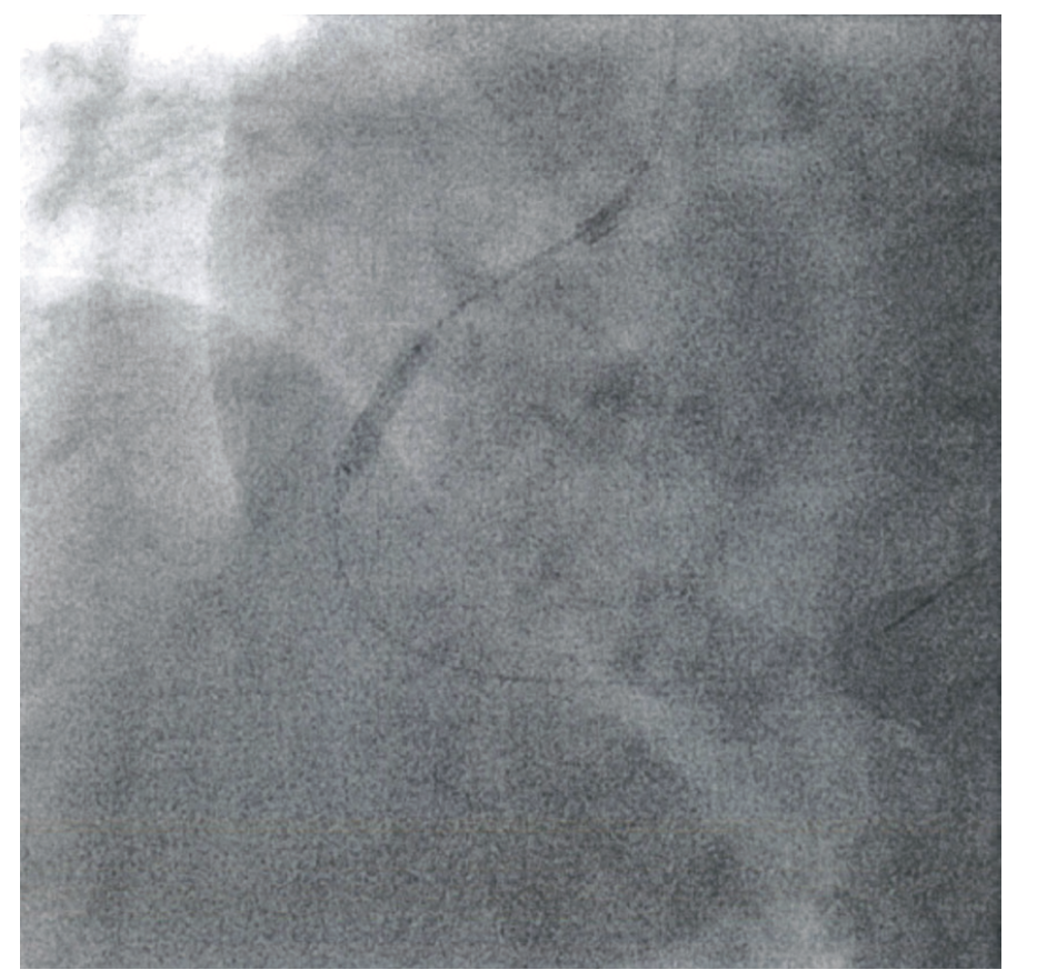 Shahab Intravascular Lithotripsy Figure 4