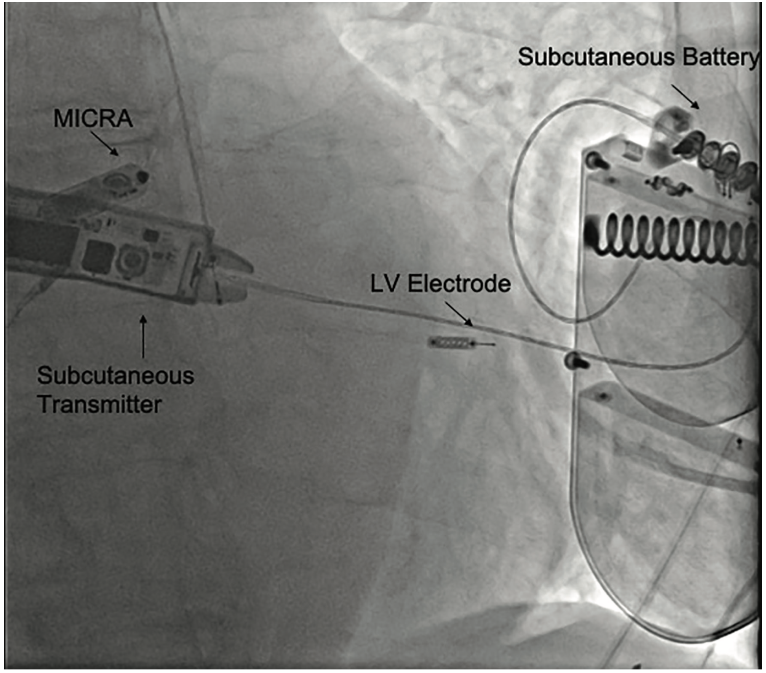 Sharma Cardiac Resynchronization Figure 4