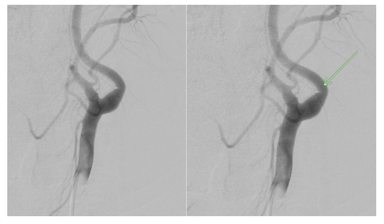 Figure 1. Digital subtraction angiographic image, which shows a small, curvilinear filling defect in the proximal left internal carotid artery reflecting a carotid web.