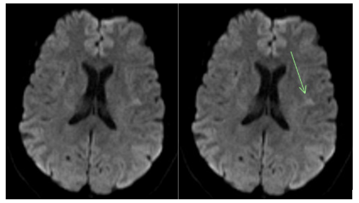 Figure 2, Follow-up diffusion-weighted MRI brain images after a negative non-contrast head CT and contrast-enhanced CT angiogram of the neck show a small acute ischemic infarct in the region of the left motor cortex/pre-central gyrus. 