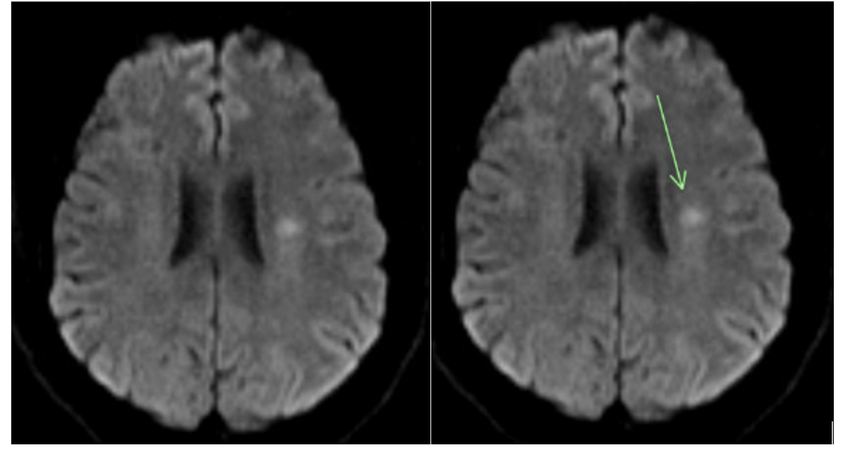 Figure 3. Follow-up diffusion-weighted magnetic resonance imaging brain images after a negative non-contrast head computed tomography (CT) scan and contrast enhanced CT angiogram of the neck show a small acute ischemic infarct in the left corona radiata. 