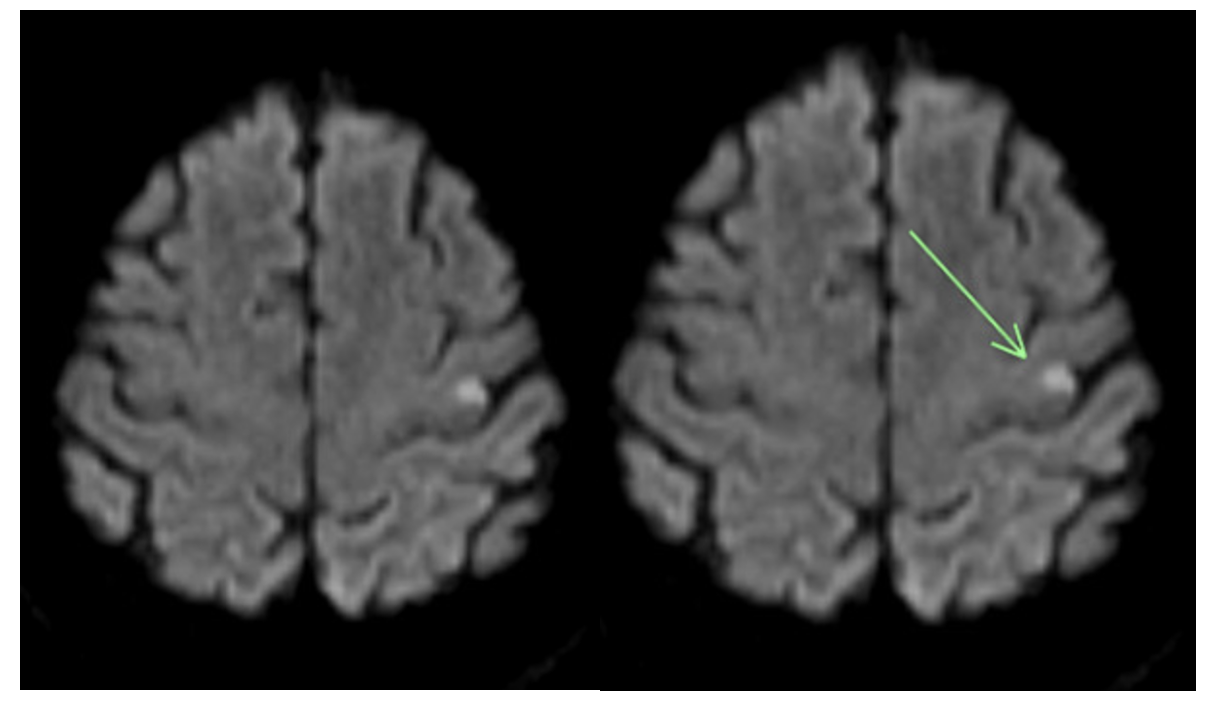 Figure 4. Follow-up diffusion-weighted magnetic resonance imaging brain images after a nega-tive non-contrast head computed tomography (CT) scan and contrast-enhanced CT angiogram of the neck show small acute cortical ischemic infarcts involving the left parietal lobe.