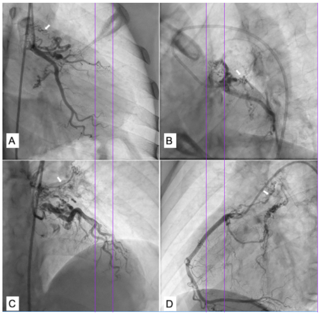 Shrimanth Aortopulmonary Figure 2