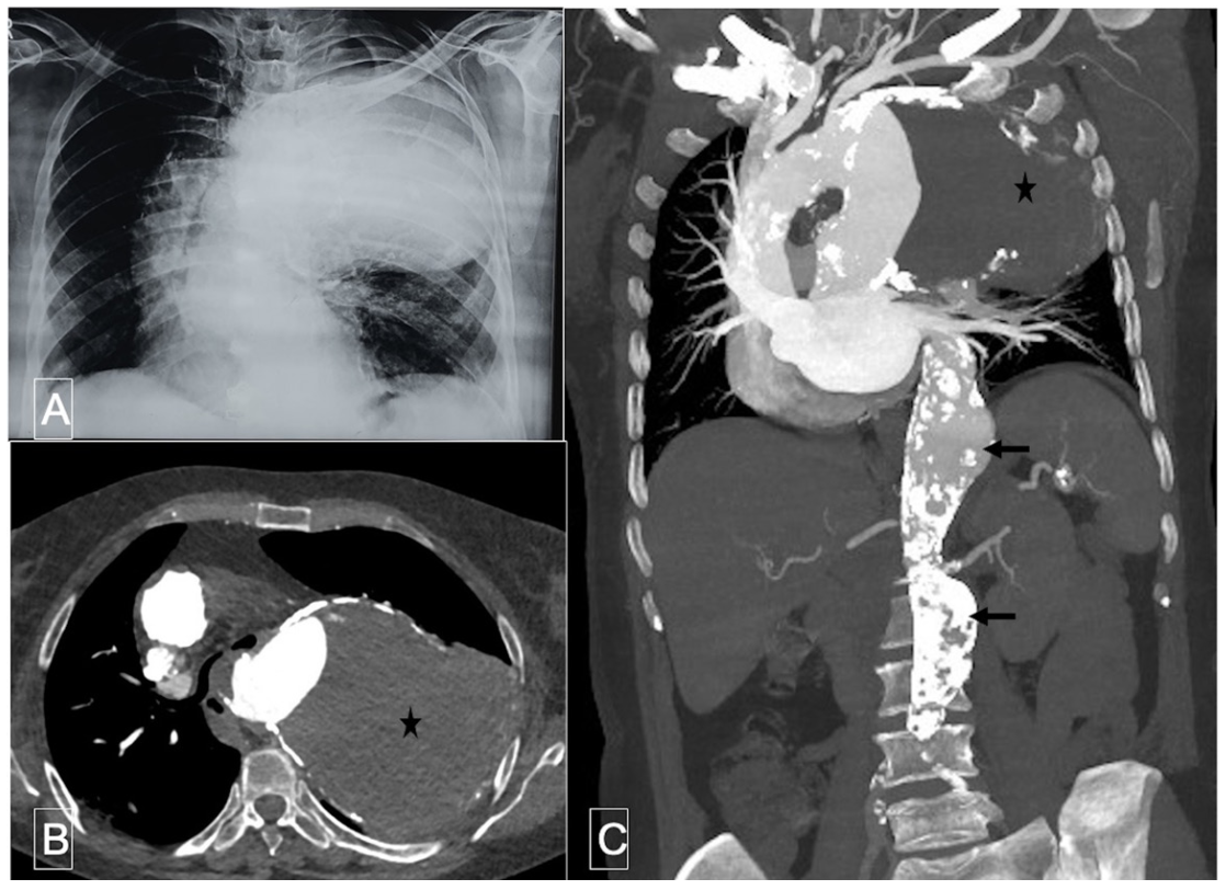 Shrimanth Ortner’s Syndrome Figure 1