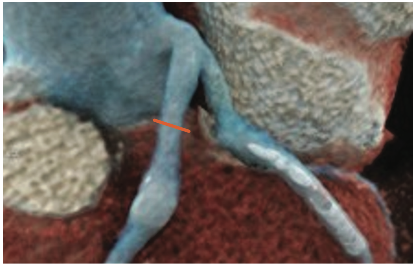 Siemens Calcification Figure 2