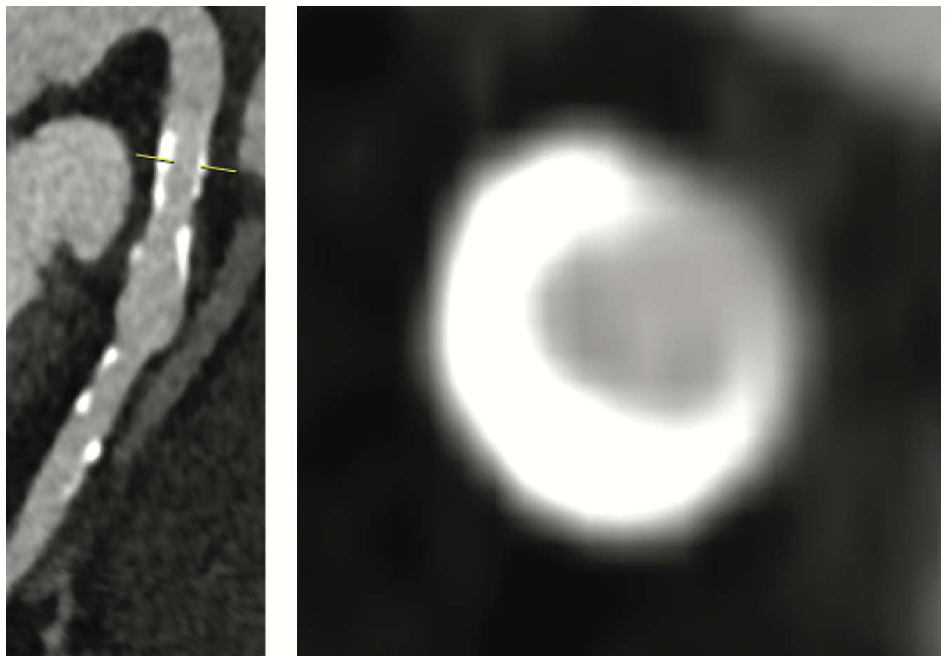 Siemens Calcification Figure 3