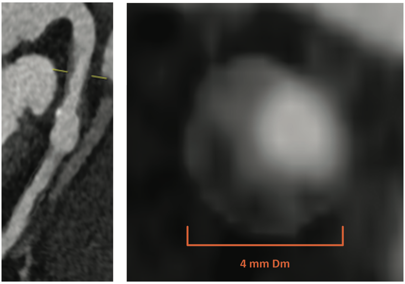 Siemens Calcification Figure 4