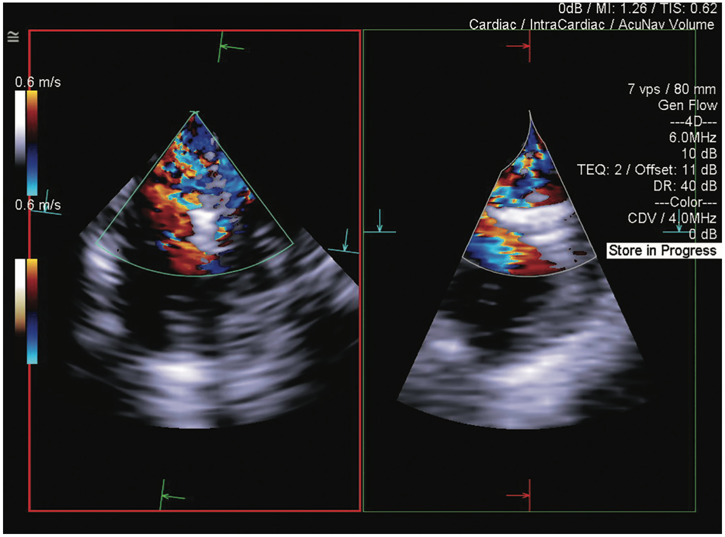Siemens Mitral Regurgitation Figure 3