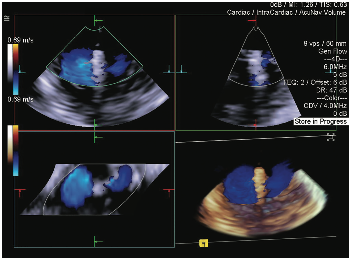 Siemens Mitral Regurgitation Figure 4