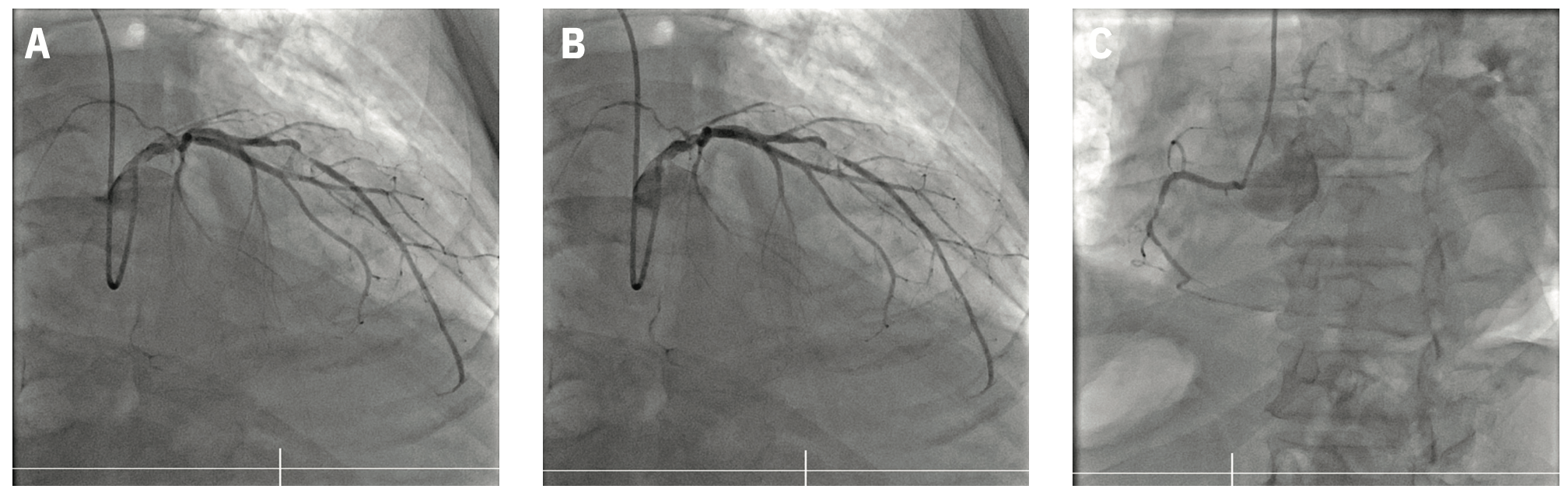 Siemens Total Occlusion Figure 1A-C