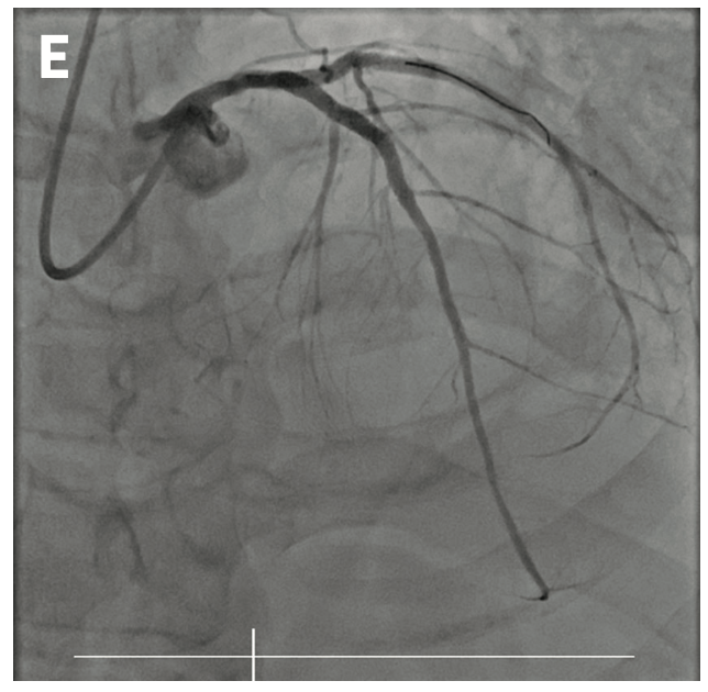 Siemens Total Occlusion Figure 1E