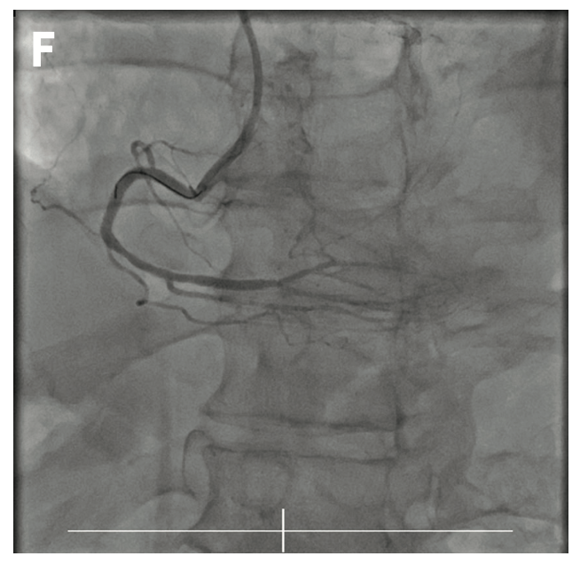 Siemens Total Occlusion Figure 1F