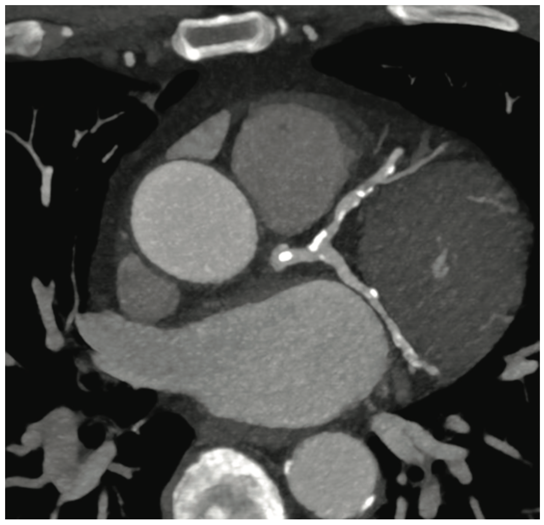 Siemens cCTA Imaging Figure 1
