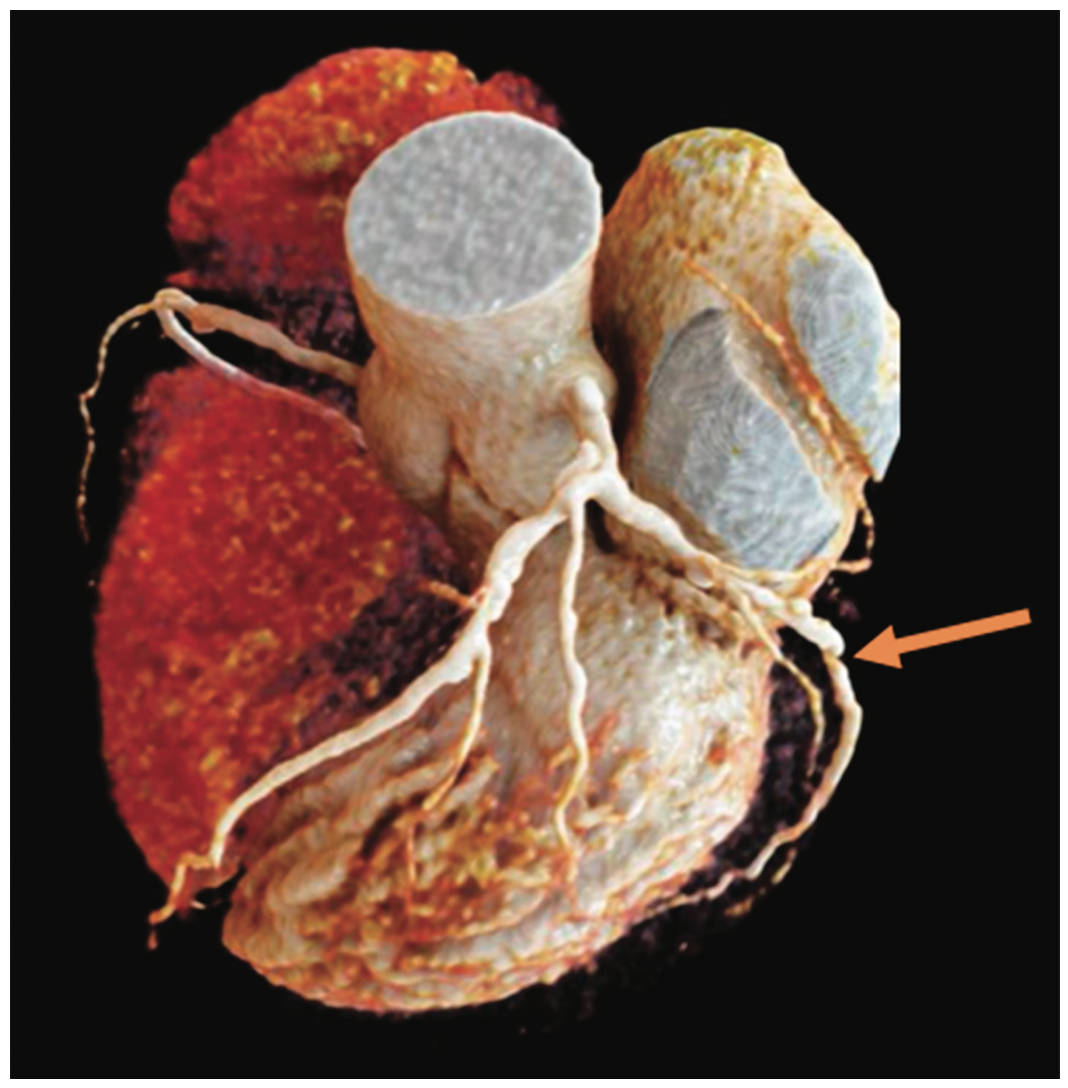 Siemens cCTA Imaging Figure 3