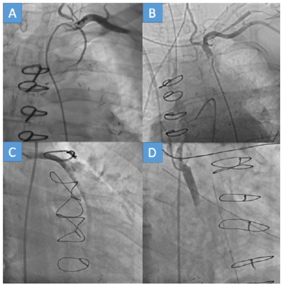 Simsek Coronary Artery Bypass Graft Figure 4
