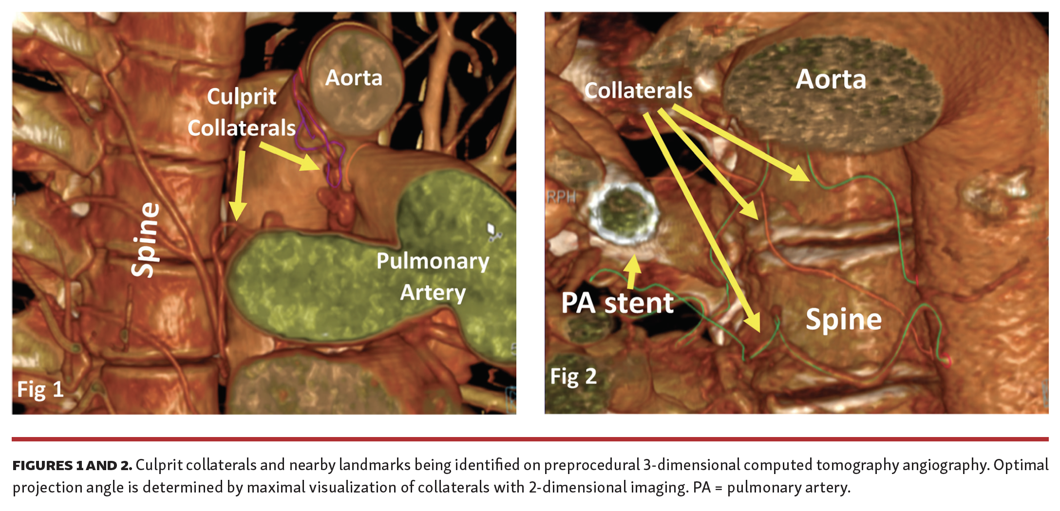 Singh CT-Fluoro Fig 1-2