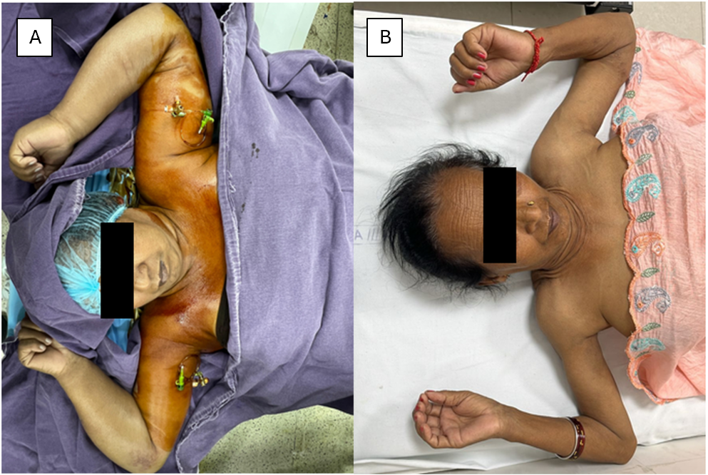 Figure 2. Before and after images of the patient, showing resolution of swelling.