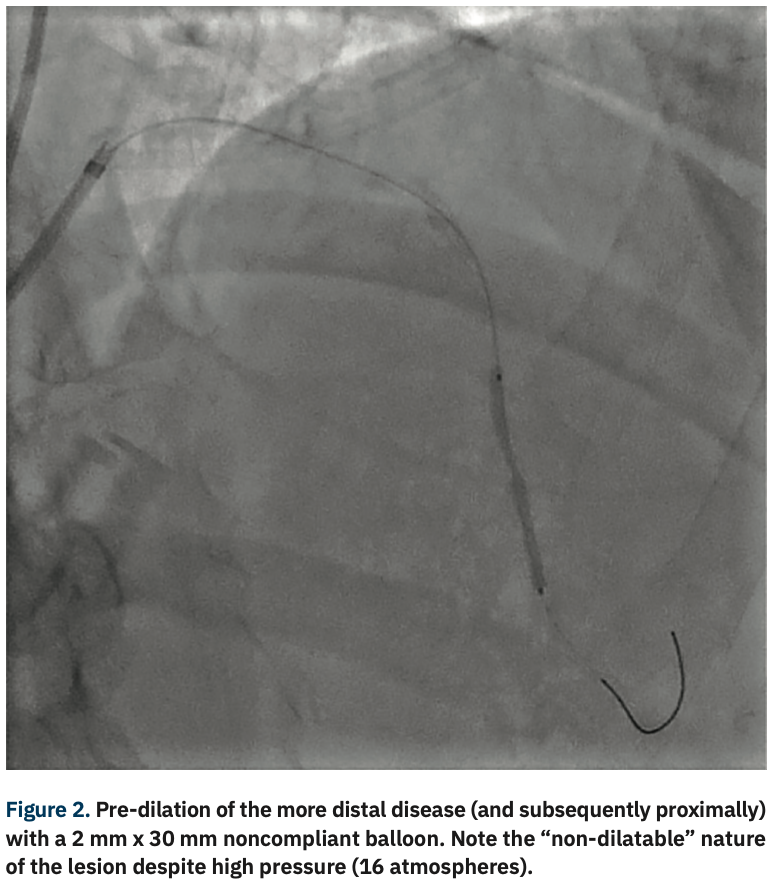 Sizemore Calcified Lesions Figure 2