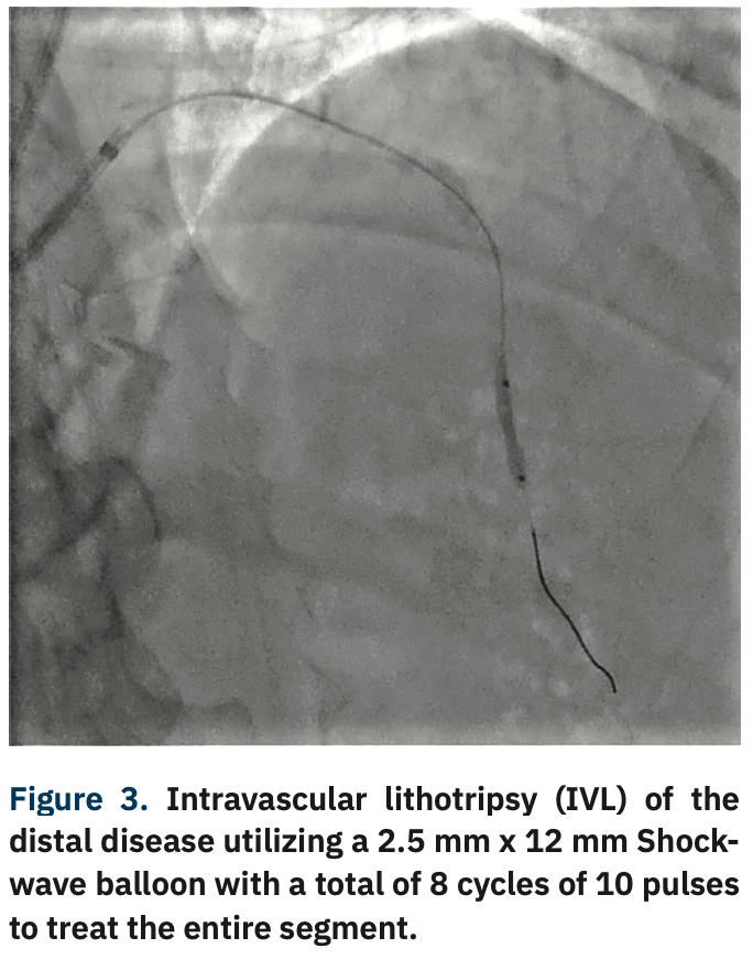 Sizemore Calcified Lesions Figure 3