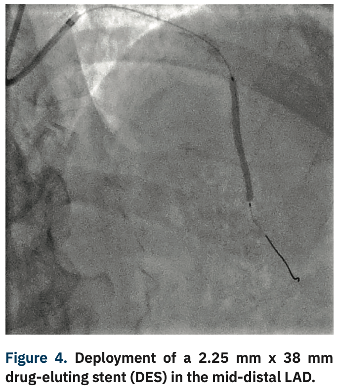 Sizemore Calcified Lesions Figure 4