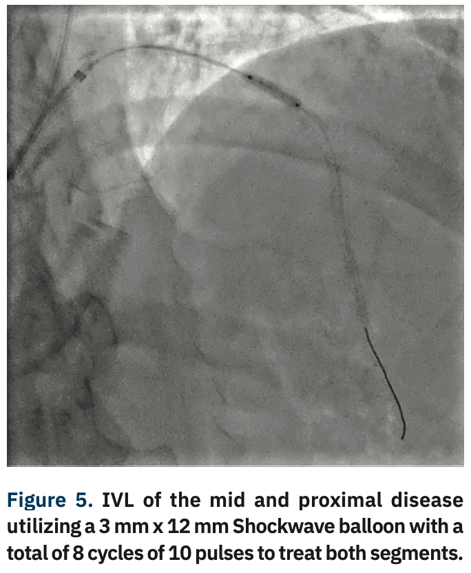Sizemore Calcified Lesions Figure 5