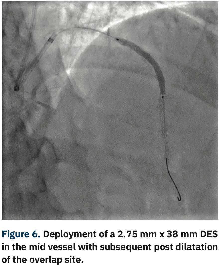 Sizemore Calcified Lesions Figure 6