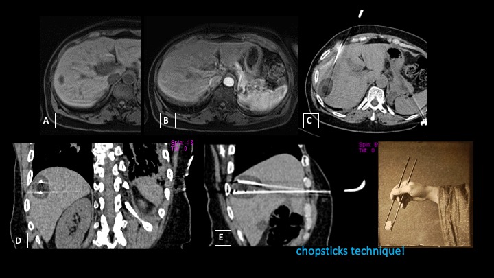 Pusceddu Figure 1 Cryoablation CRC