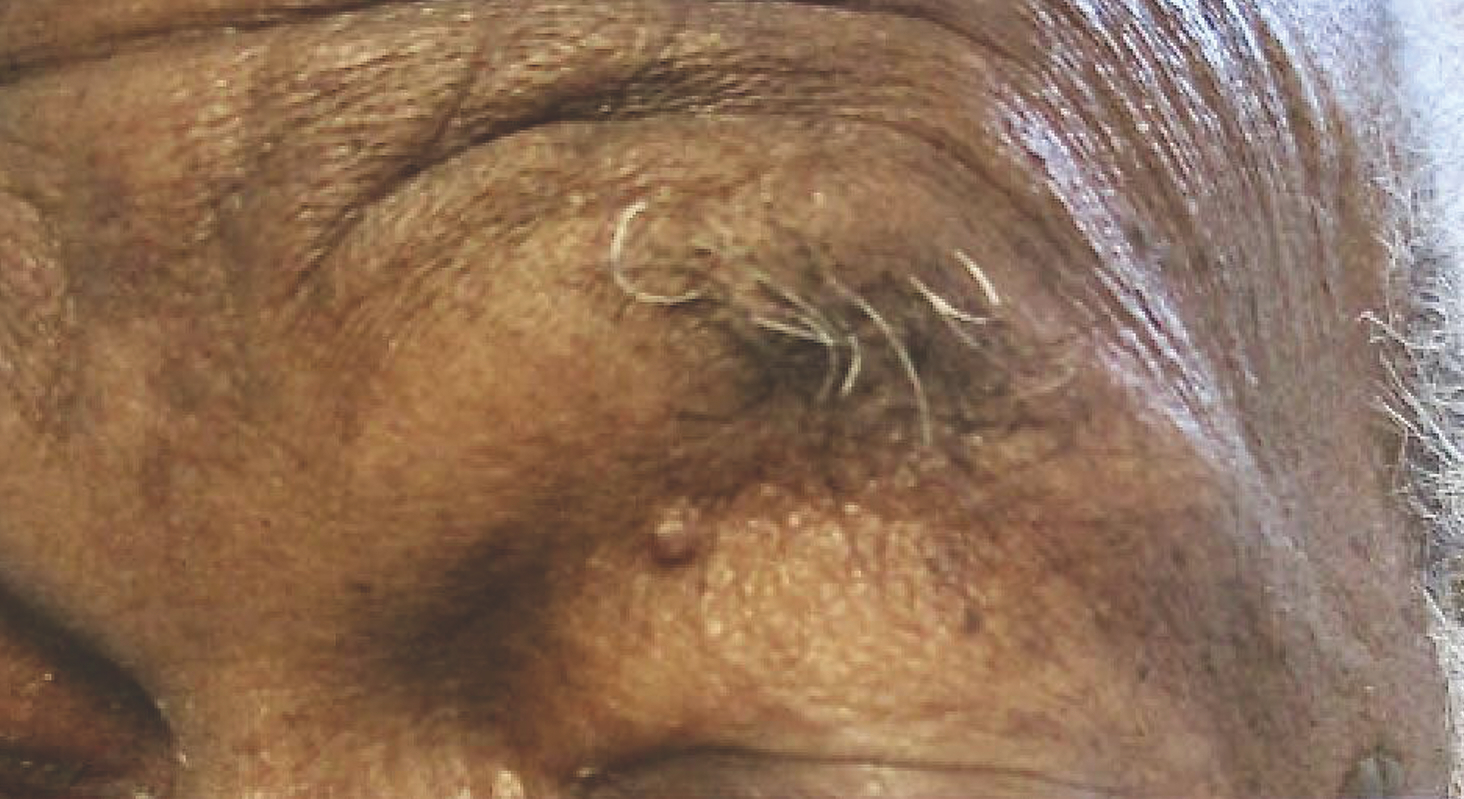 erythematous papule with a yellowish hue and telan- giectasias on the left eyelid