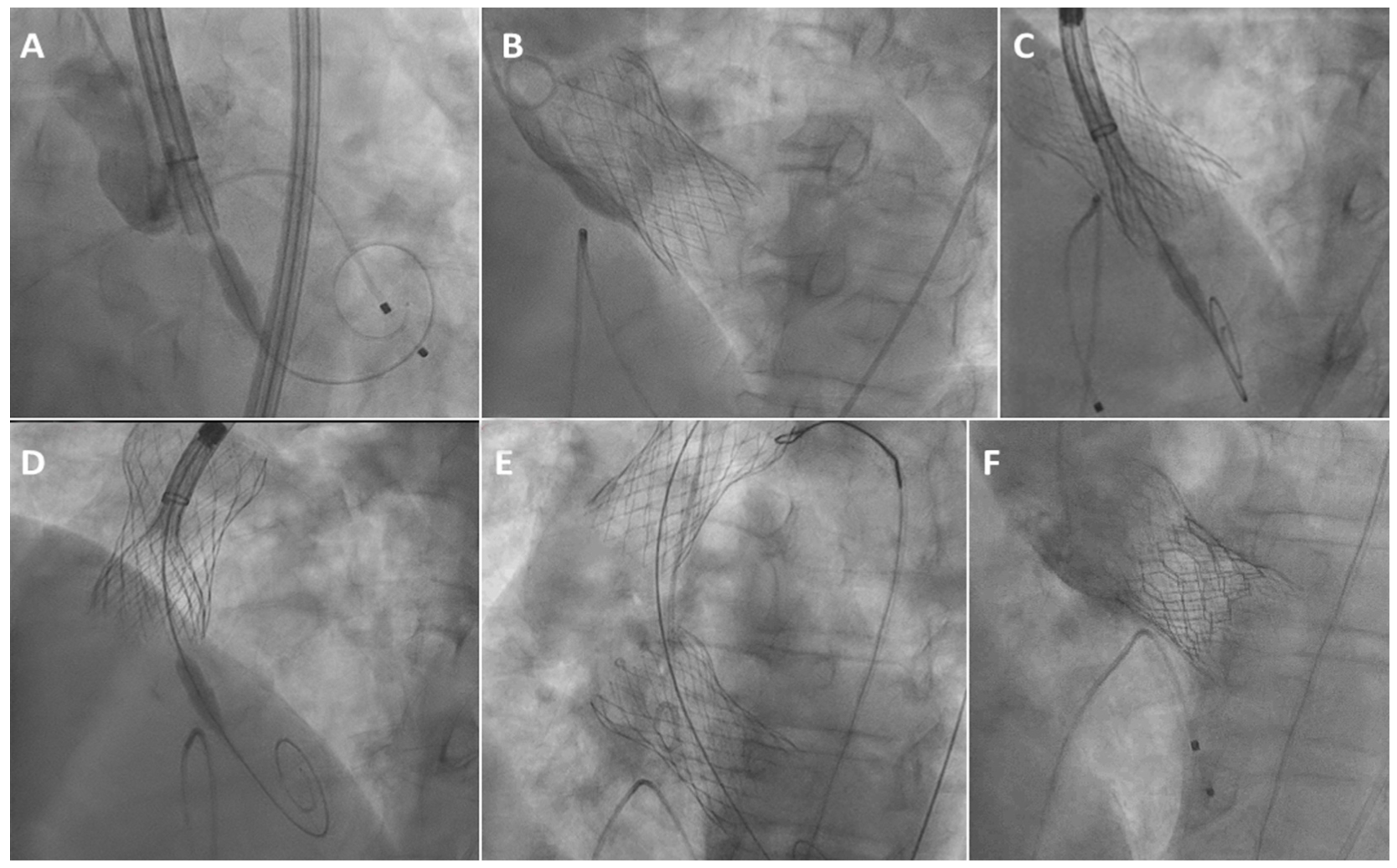 Journa of Invasive Cardiology: Valve Migration