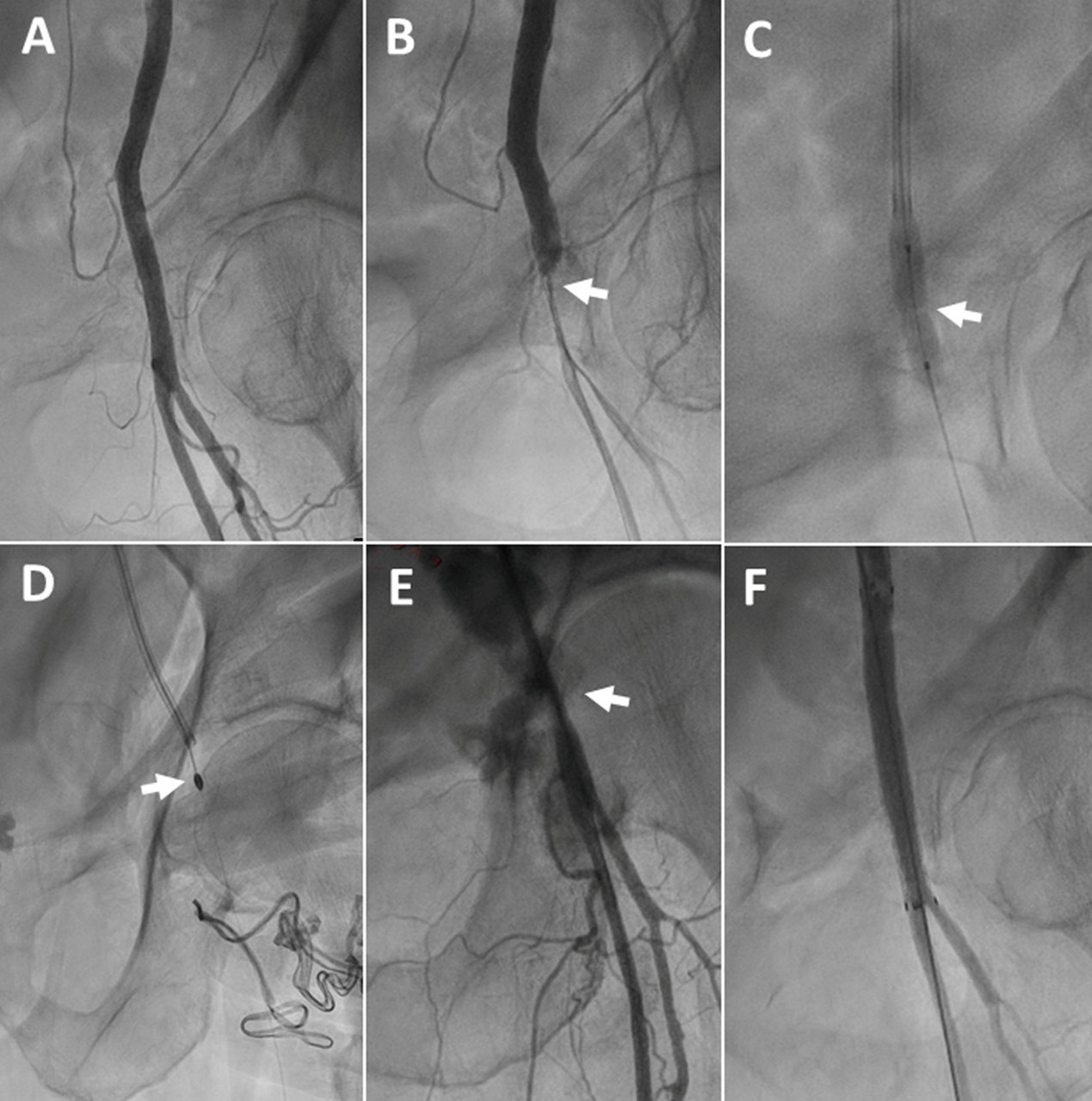 Figure 2. Left femoral artery stenosis