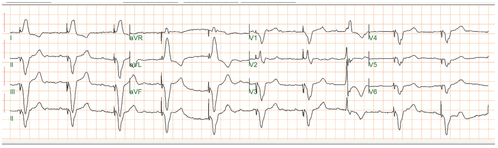 Smith Tachycardia Figure 1